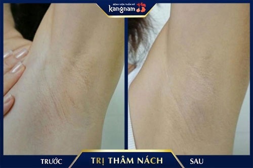 trị thâm nách bằng bột baking soda 