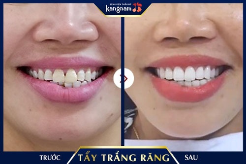 ê buốt răng sau khi tẩy trắng