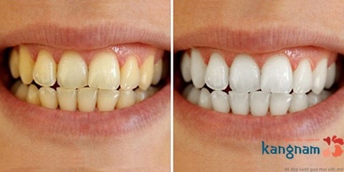 tẩy trắng răng ê buốt bao lâu
