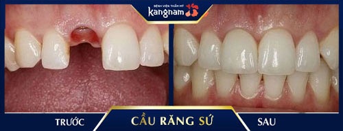 Làm cầu răng toàn sứ cho răng giả tự nhiên như thật giá cầu răng sứ