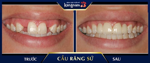 Khách hàng làm cầu răng sứ Titan hai răng bị mất đẹp tự nhiên giá làm cầu răng sứ