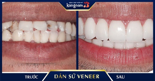 giá mặt dán sứ veneer giá mặt dán sứ veneer