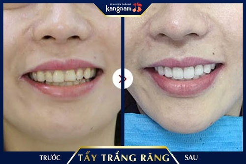 làm thế nào để hết ê buốt răng