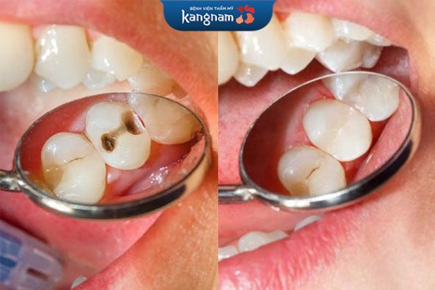 Lỗ hổng răng sâu được phủ kín, đều màu sau trám lại răng hàm