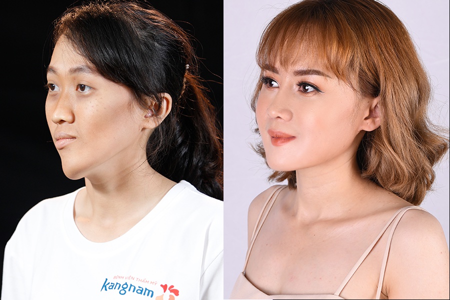 Góc nghiêng trái: Góc hàm thô bạnh trở nên thon gọn, mềm mại theo dáng khuôn mặt