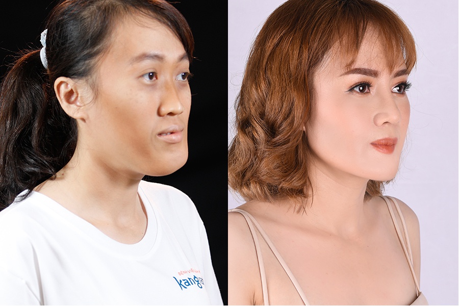 Góc nghiêng phải: Xương hàm quát phát được thu gọn cân xứng, mũi cao thẳng tự nhiên