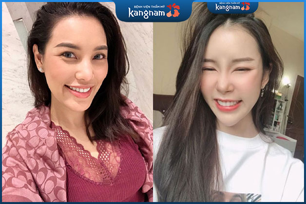 Chị Hòa khoe hàm răng trắng sau khi làm trắng