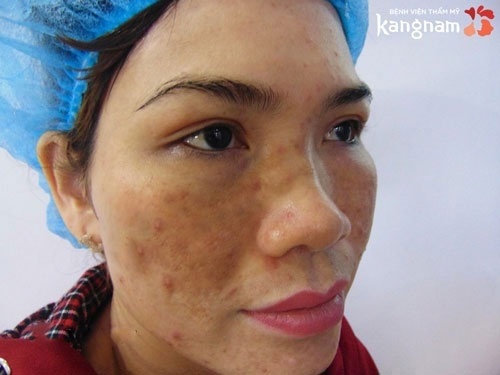 kiêng ăn gì để không bị sẹo thâm kiêng ăn gì để không bị sẹo thâm