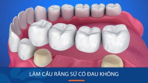 Cầu răng sứ 5S Kangnam – Giải pháp phục hình răng