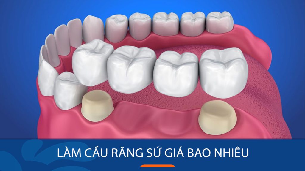 Làm cầu răng sứ giá bao nhiêu tiền? Bảng Chi phí Bắc cầu răng