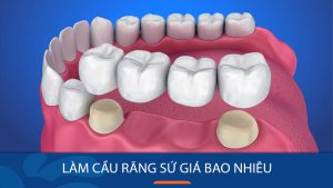Làm cầu răng sứ giá bao nhiêu tiền? Bảng Chi phí Bắc cầu răng