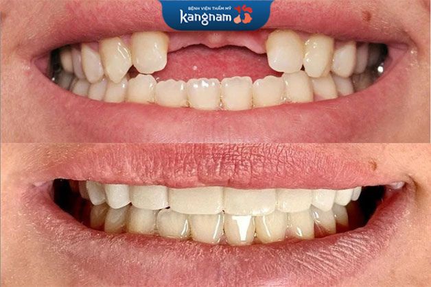 Khắc phục tình trạng mất răng cho nụ cười tự tin hơn