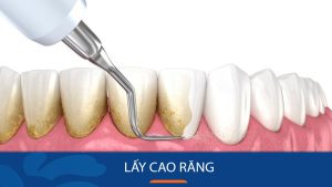 Lấy cao răng siêu âm – Hết sạch mảng bám – Răng trắng đẹp