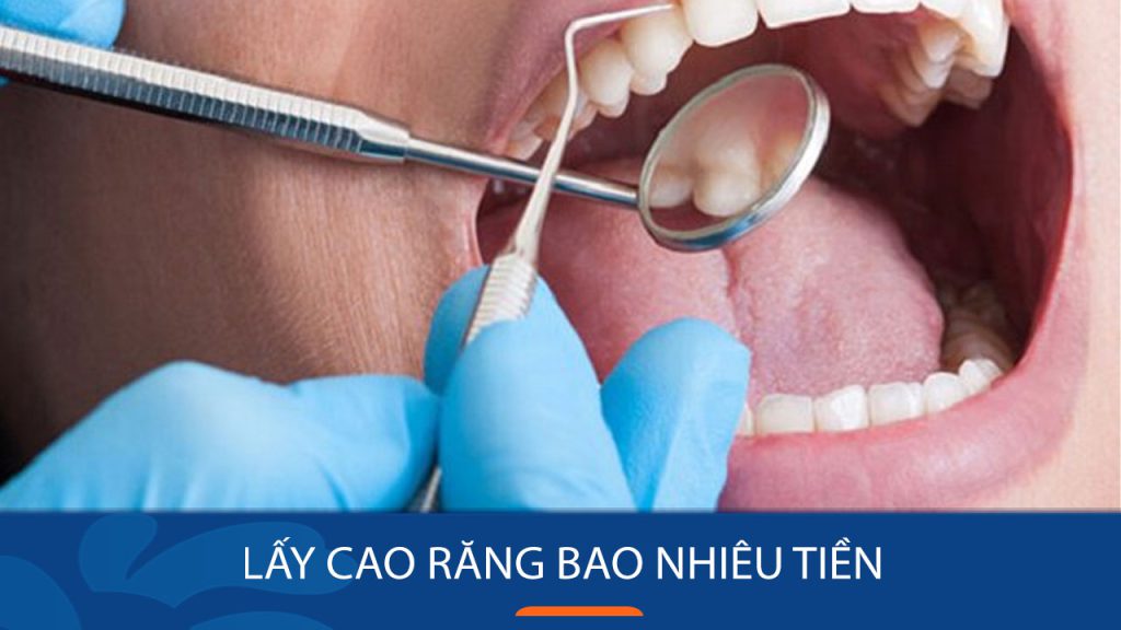Chi phí lấy cao răng bao nhiêu tiền