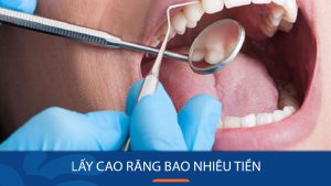 Chi phí lấy cao răng bao nhiêu tiền
