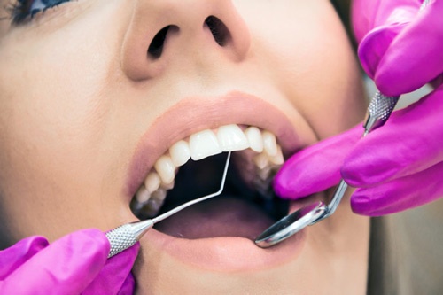 Cạo vôi răng được hỗ trợ bởi máy siêu âm nên thực hiện nhẹ nhàng, nhanh chóng bảng giá cạo vôi răng