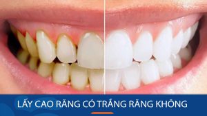 Lấy cao răng có trắng răng không? Bác sỹ Kangnam