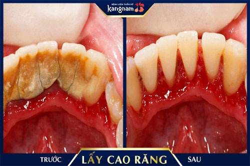 lấy cao răng sau sinh lấy cao răng sau sinh