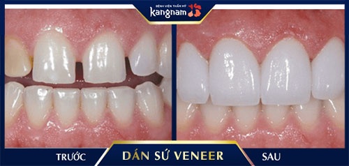 mặt dán sứ veneer mặt dán sứ veneer