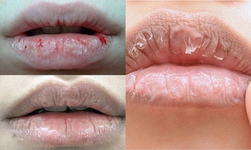 Môi khô, bong tróc nhiều có thể làm sắc tố thâm xỉn nhanh chóng Môi bị khô, bong tróc thường xuyên