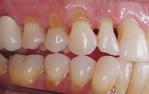 Hình ảnh cổ răng bị mòn gây ê buốt, đau nhức răng mòn cổ răng