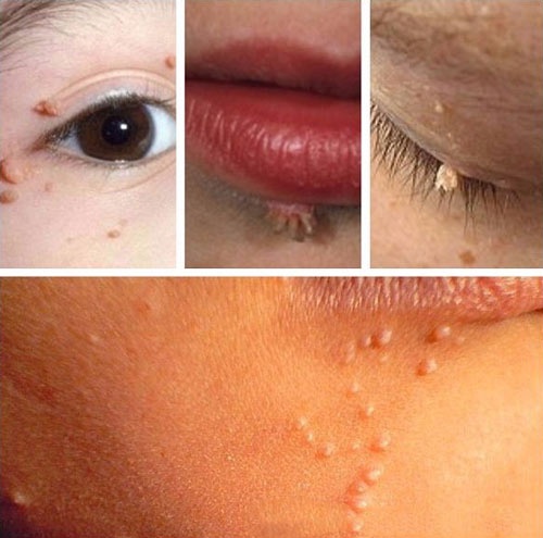 Tình trạng mụn cóc trên mặt với nhiều vị trí dưới mắt, trên môi, mi mắt,... mụn cơm ở mặt