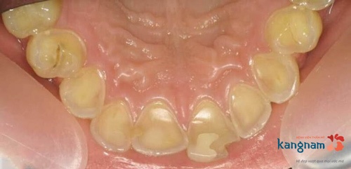 cạo vôi răng bị ê buốt