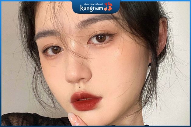 Nốt ruồi ở nhân trung