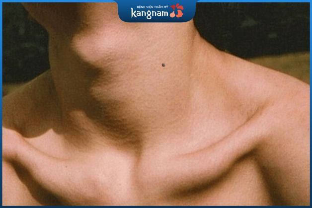 Nam giới sở hữu nốt ruồi trên cổ thường có tính nóng vội