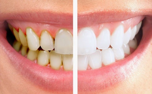 phụ nữ sau sinh có nên lấy cao răng phụ nữ sau sinh có nên lấy cao răng