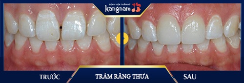 Trám kẽ hở giữa 2 răng cửa thưa giúp anh Phong (Hải Phòng) tự tin hơn hẳn khi giao tiếp với khách hàng răng cửa thưa và cách khắc phục