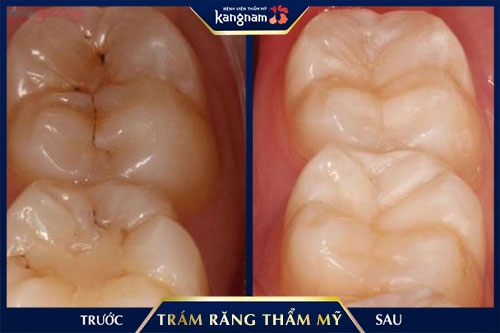 hàn răng sâu cho trẻ em 