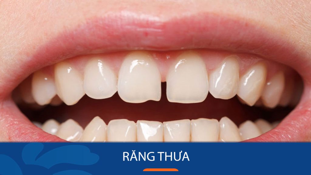 Răng thưa và các khắc phục hiệu quả sau 15 phút