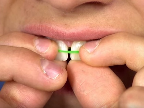 Dùng dây chun buộc 2 răng thưa để chúng sít lại gần nhau hơn răng thưa nên làm gì