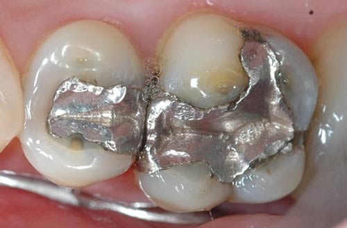 Răng trám lâu ngày bị nhức do bị hở phần răng, chất liệu trám răng kém chất lượng răng trám lâu ngày bị nhức