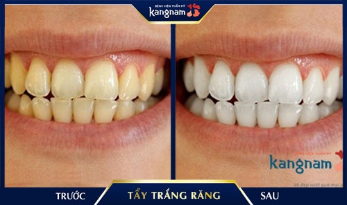 răng trắng bóng trong 5 phút răng trắng bóng trong 5 phút