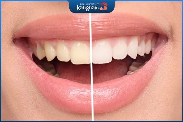 Kiêng son môi đậm màu để tránh ảnh hưởng tới màu răng