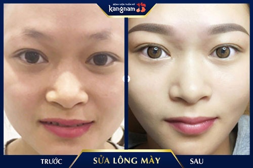 sửa lông mày xăm hỏng