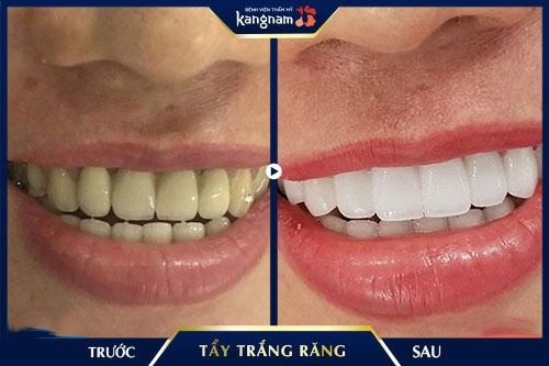 tẩy trắng răng có hại gì không 