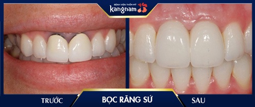 điều trị nướu răng bị đen tại sao nướu răng bị đen