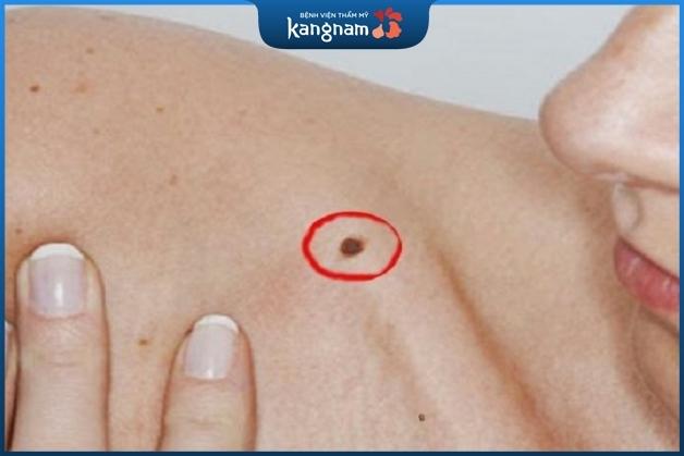 Nên tẩy bỏ nốt ruồi