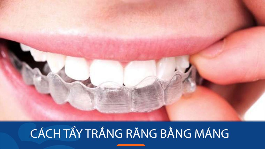 Cách tẩy trắng răng bằng máng tại nhà – Đơn giản