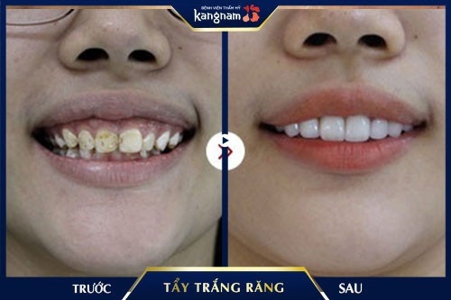 tác hại của tẩy trắng răng 