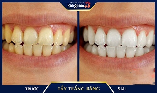 Hiệu quả tẩy trắng răng giữ được bao lâu tùy thuộc vào phương pháp áp dụng chăm sóc răng sau khi tẩy trắng