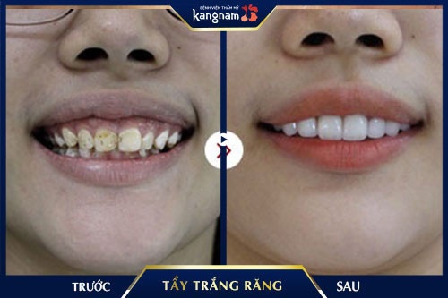 tẩy trắng răng nha khoa tẩy trắng răng nha khoa