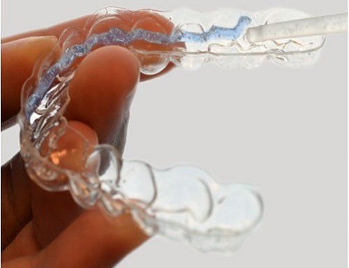 Tẩy trắng răng bằng máng tại nhà được nhiều người áp dụng vì tiện lợi, hiệu quả bao lâu tẩy trắng răng 1 lần