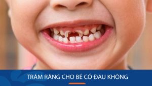 Trám răng cho bé có đau không? Nên trám răng cho bé
