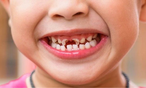 trám răng sữa trám răng sữa