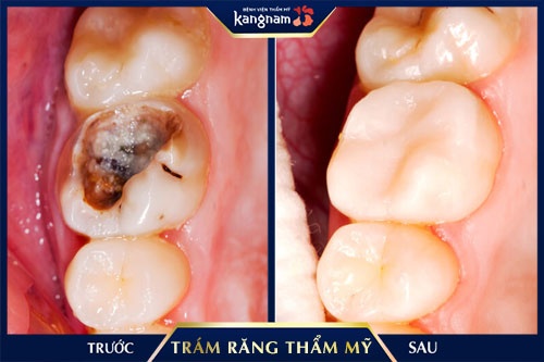 trẻ em có nên trám răng không trẻ em có nên trám răng không