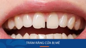 Trám răng cửa bị mẻ – Phục hình răng đều, đẹp – Tự tin cười xinh